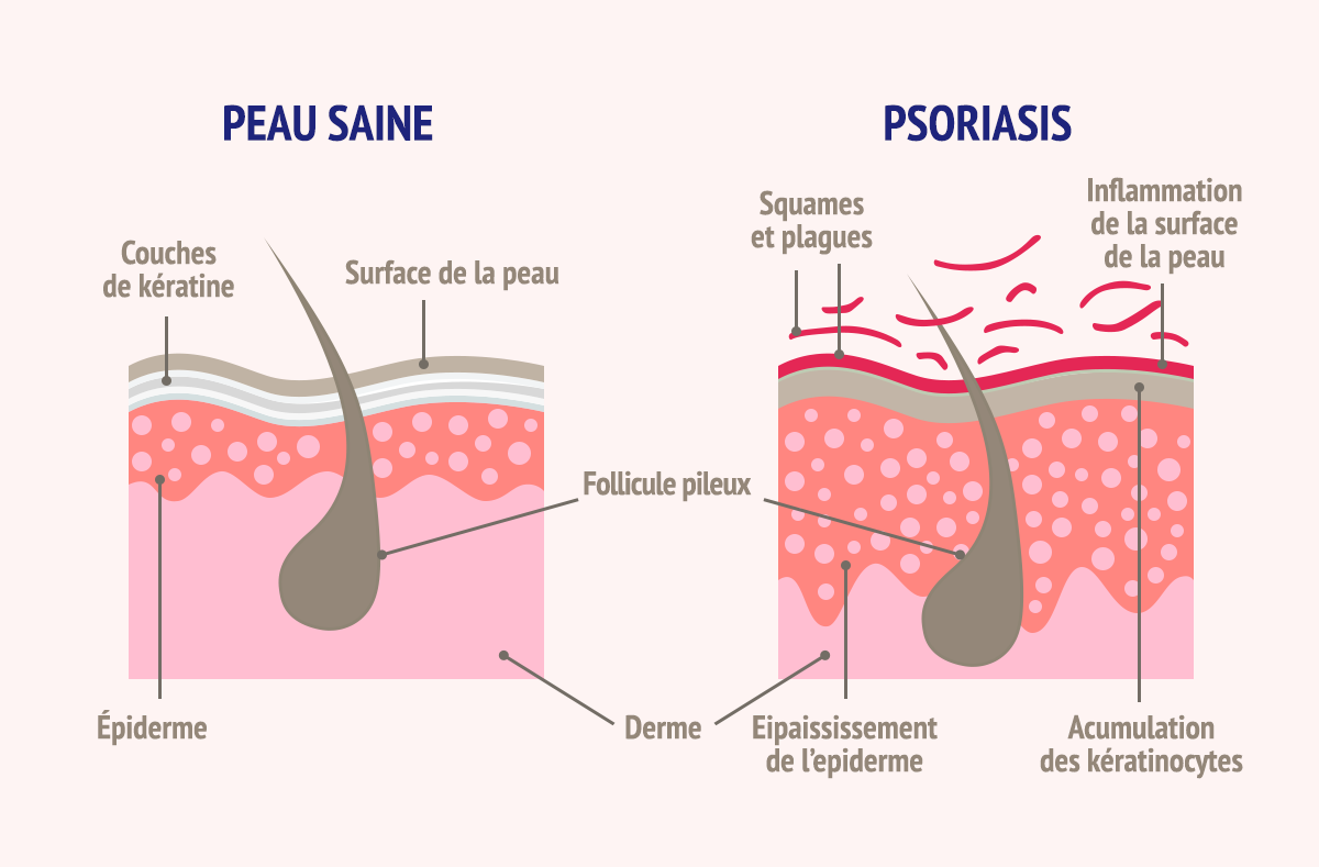 Psoriasis : traitement naturel du cuir chevelu et des ...