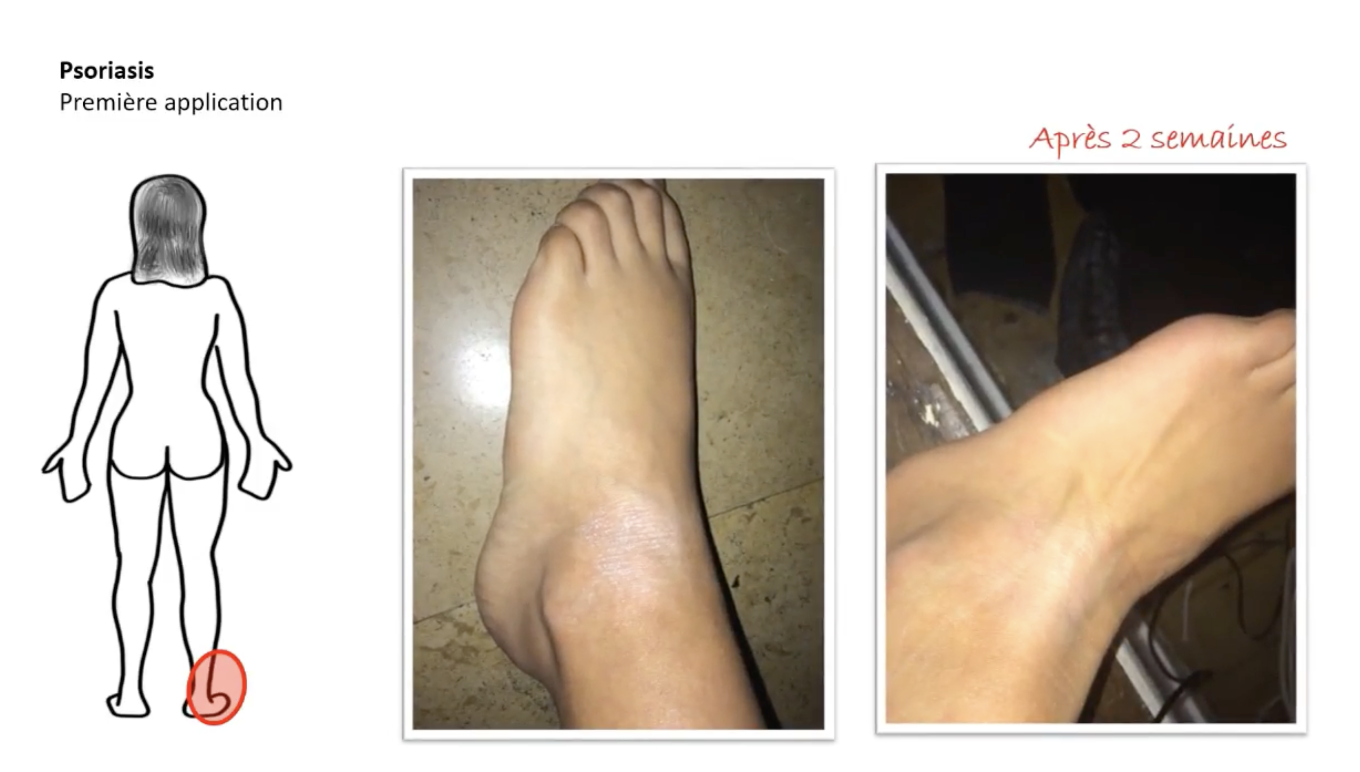 psoriasis pieds photos